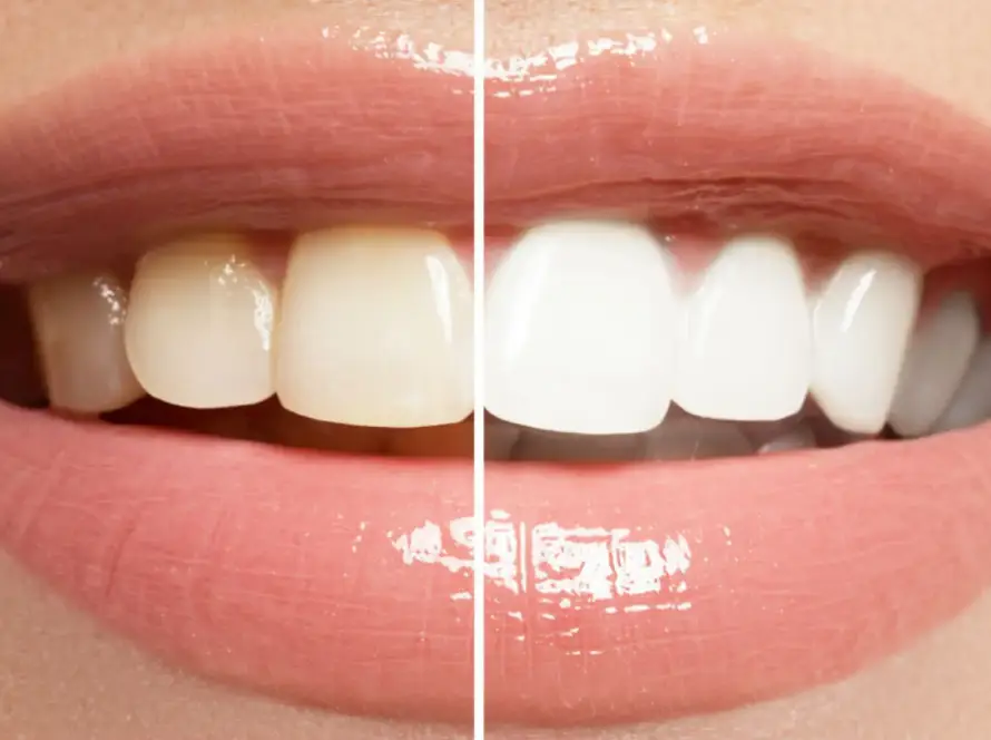 Is Teeth Whitening Safe?