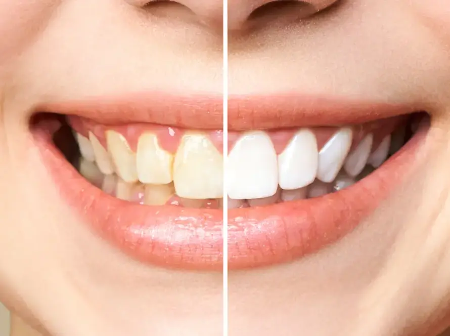 Reliable Teeth Whitening Methods