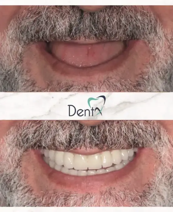 Dentx-Dental-Implant-Before-Afters-2