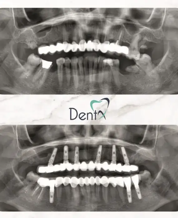 Dentx-Dental-Implant-Before-Afters-3
