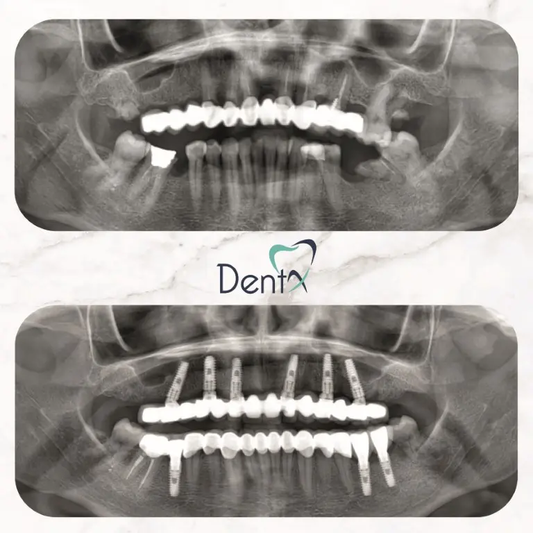 Dentx-Dental-Implant-Before-Afters-3