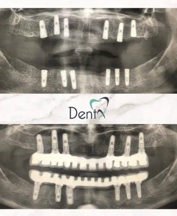 Dentx-Dental-Implant-Before-Afters-4