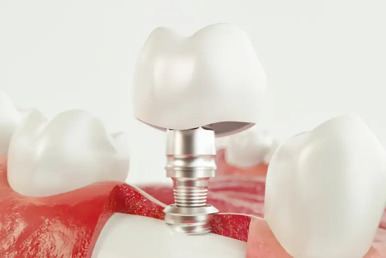 Dental Implants