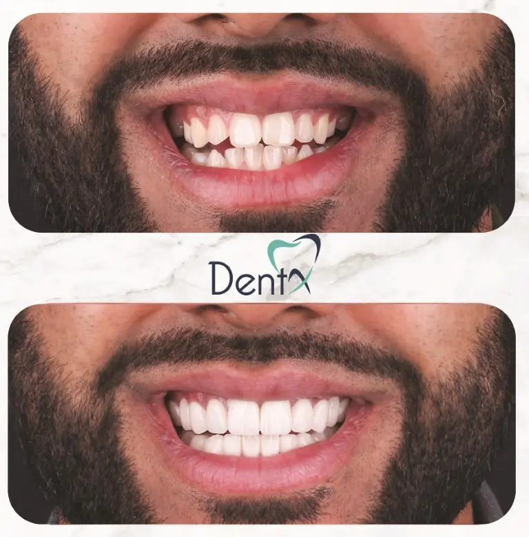 Dentx-Digital-Smile-Design-Hollywood-Smile-Before-Afters-1