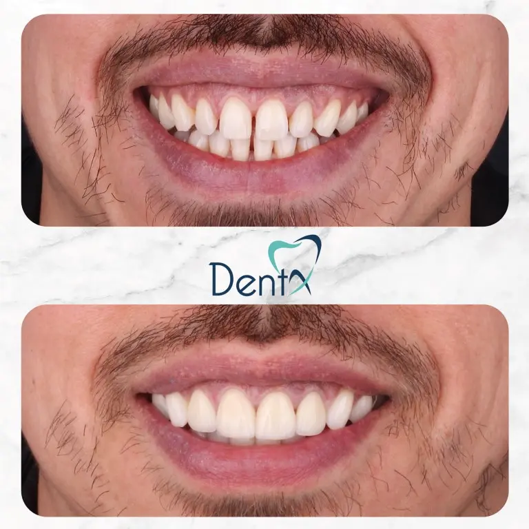 Dentx-Digital-Smile-Design-Hollywood-Smile-Before-Afters-10