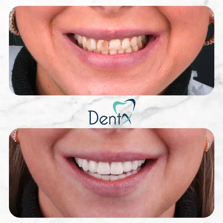 Dentx-Digital-Smile-Design-Hollywood-Smile-Before-Afters-11