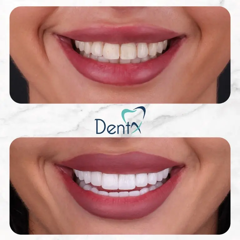 Dentx-Digital-Smile-Design-Hollywood-Smile-Before-Afters-12