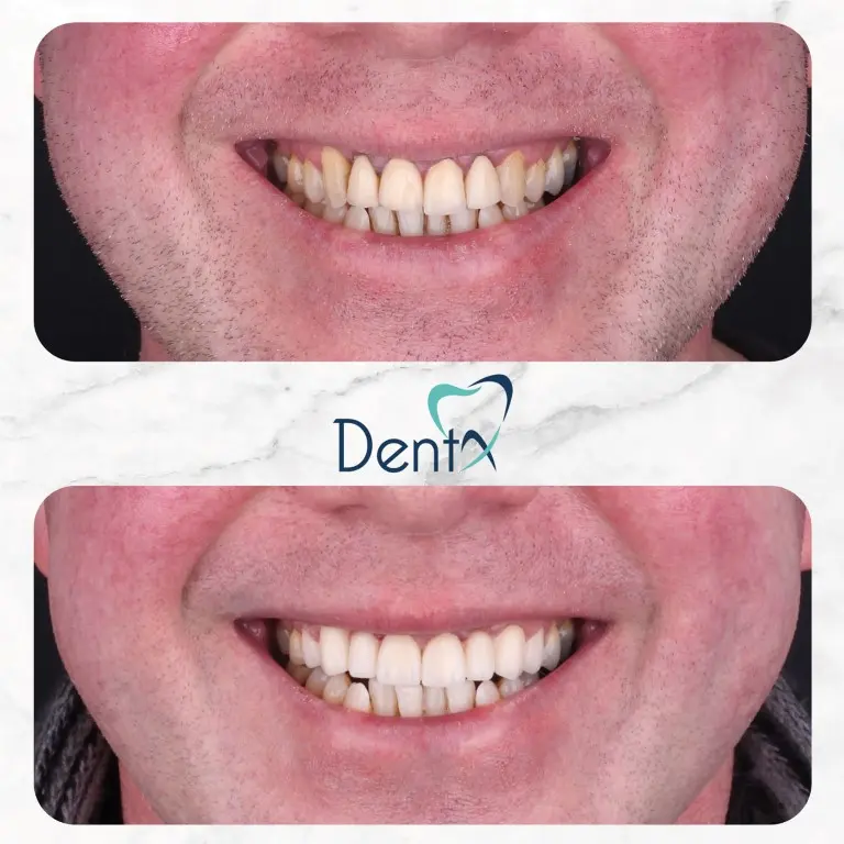 Dentx-Digital-Smile-Design-Hollywood-Smile-Before-Afters-13