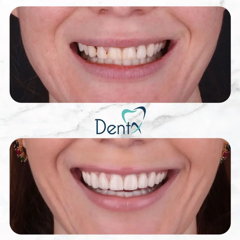 Dentx-Digital-Smile-Design-Hollywood-Smile-Before-Afters-15