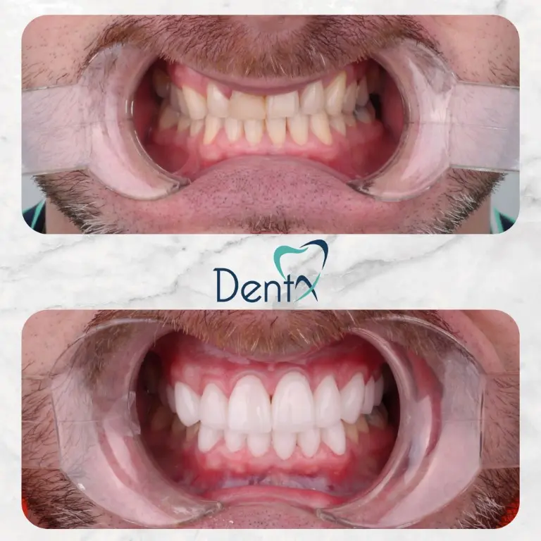 Dentx-Digital-Smile-Design-Hollywood-Smile-Before-Afters-18