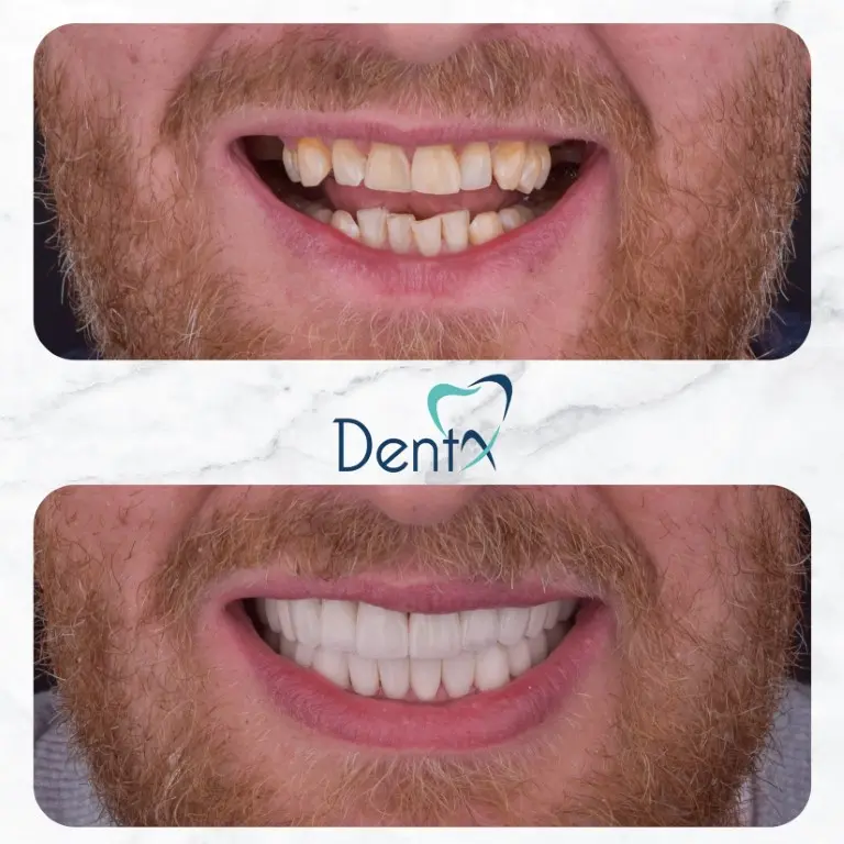 Dentx-Digital-Smile-Design-Hollywood-Smile-Before-Afters-19