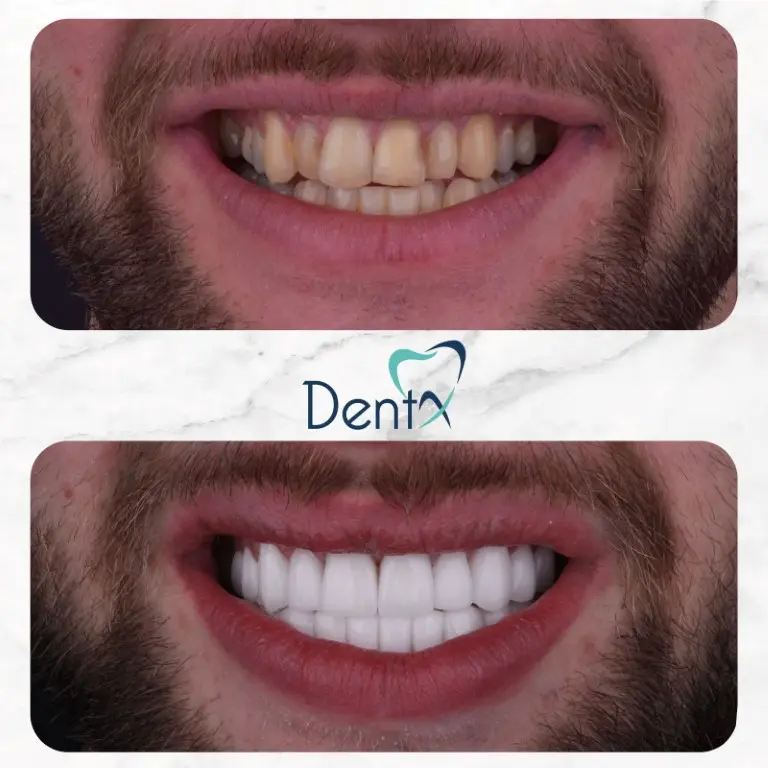 Dentx-Digital-Smile-Design-Hollywood-Smile-Before-Afters-2