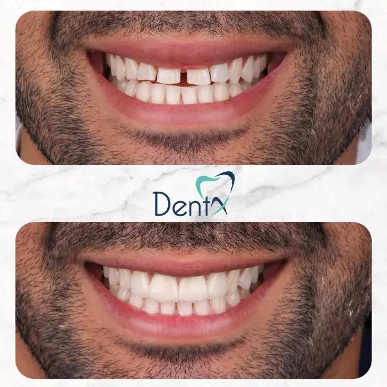 Dentx-Digital-Smile-Design-Hollywood-Smile-Before-Afters-20