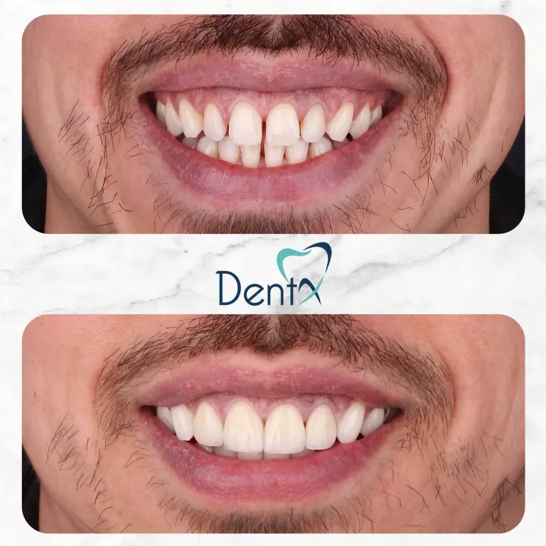 Dentx-Digital-Smile-Design-Hollywood-Smile-Before-Afters-21