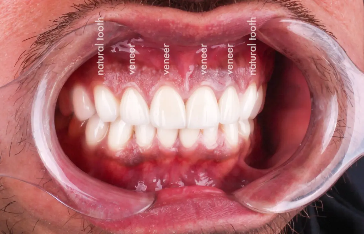 Dentx-Digital-Smile-Design-Hollywood-Smile-Before-Afters-22