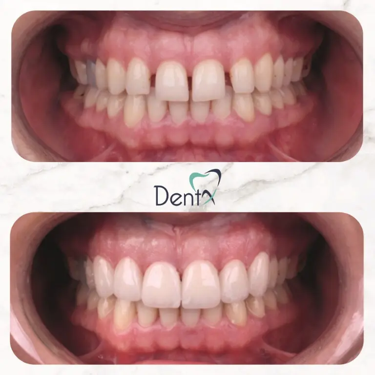 Dentx-Digital-Smile-Design-Hollywood-Smile-Before-Afters-23