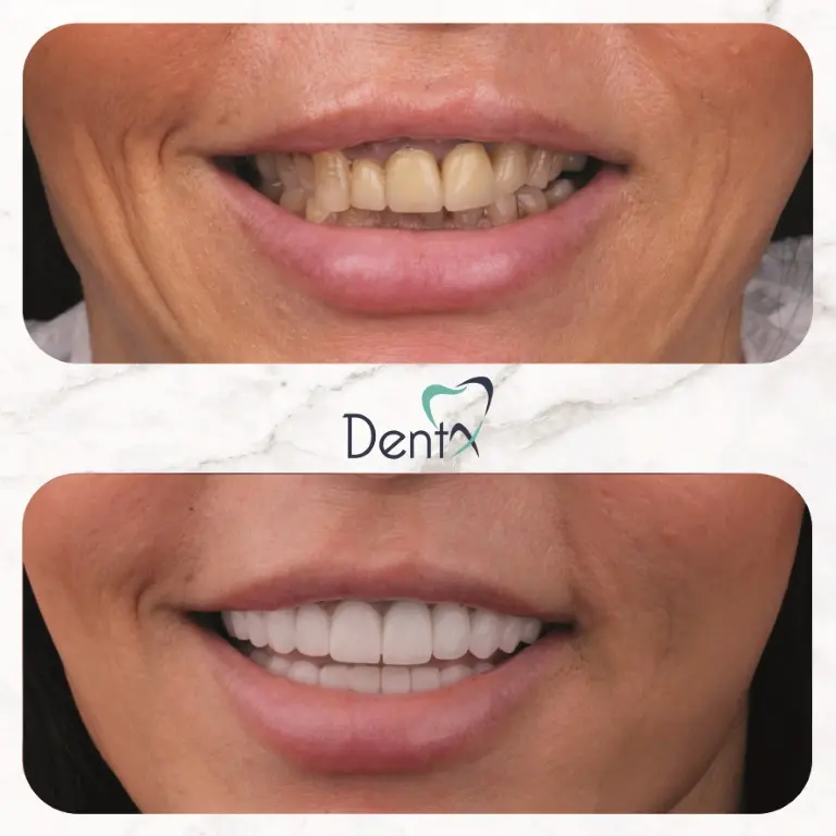 Dentx-Digital-Smile-Design-Hollywood-Smile-Before-Afters-24