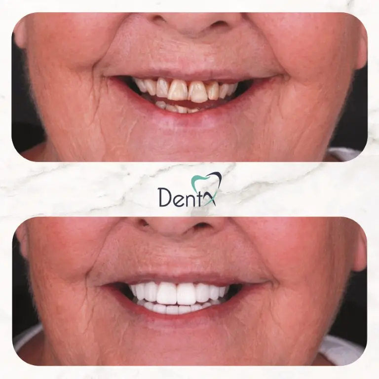 Dentx-Digital-Smile-Design-Hollywood-Smile-Before-Afters-26