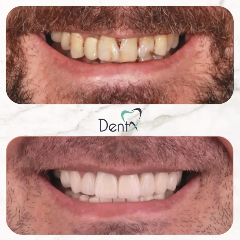 Dentx-Digital-Smile-Design-Hollywood-Smile-Before-Afters-27