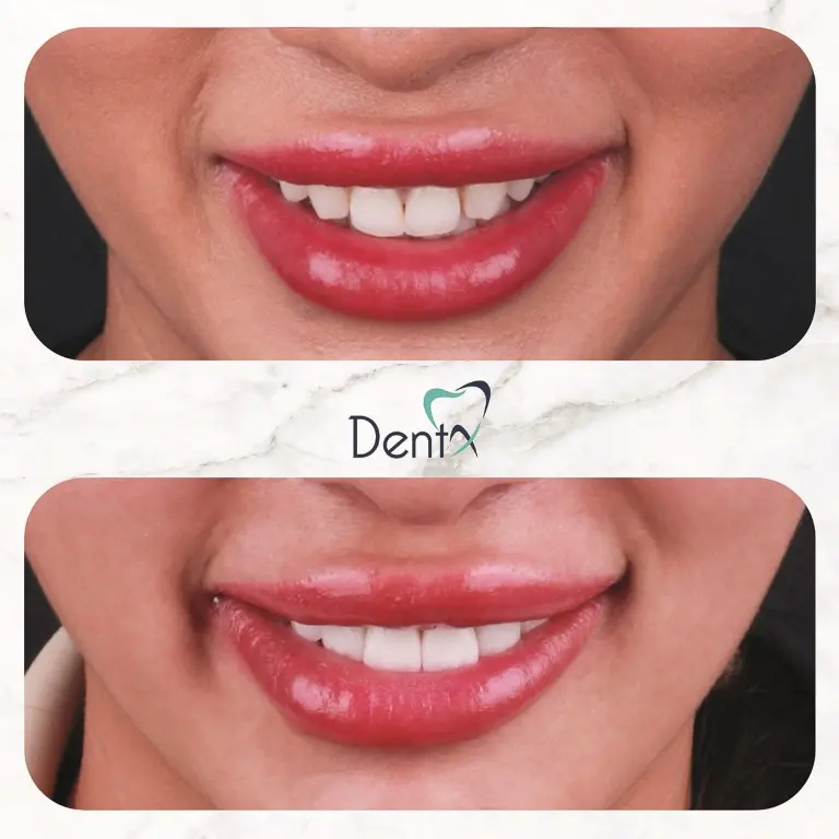 Dentx-Digital-Smile-Design-Hollywood-Smile-Before-Afters-29