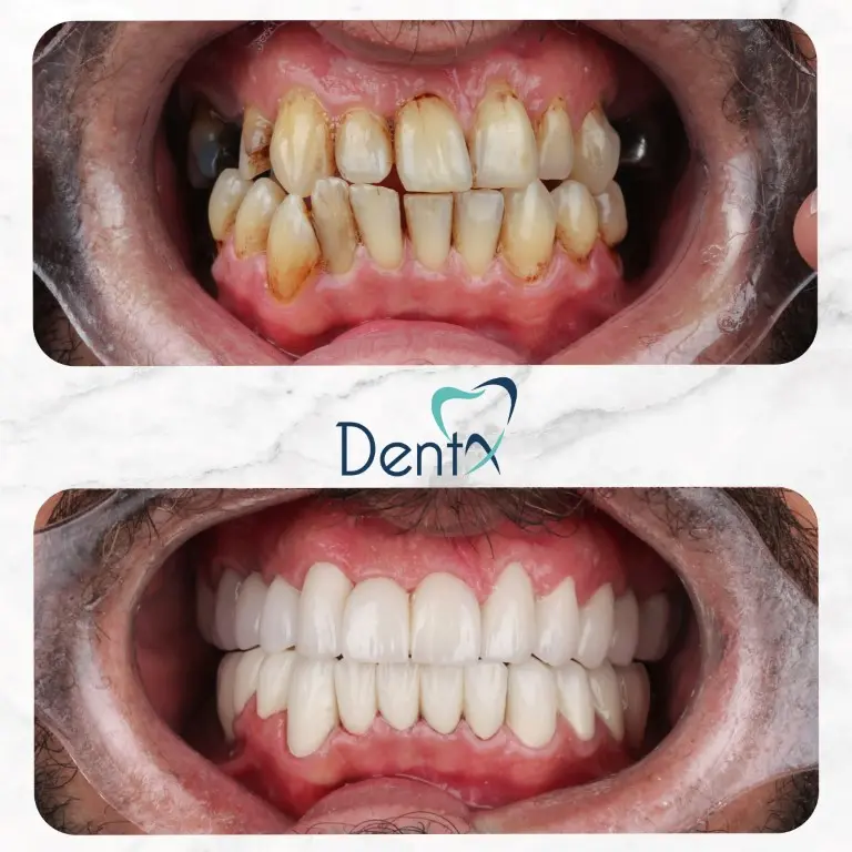 Dentx-Digital-Smile-Design-Hollywood-Smile-Before-Afters-3
