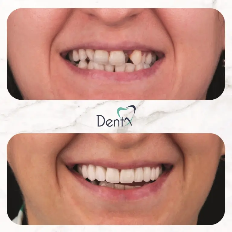 Dentx-Digital-Smile-Design-Hollywood-Smile-Before-Afters-32