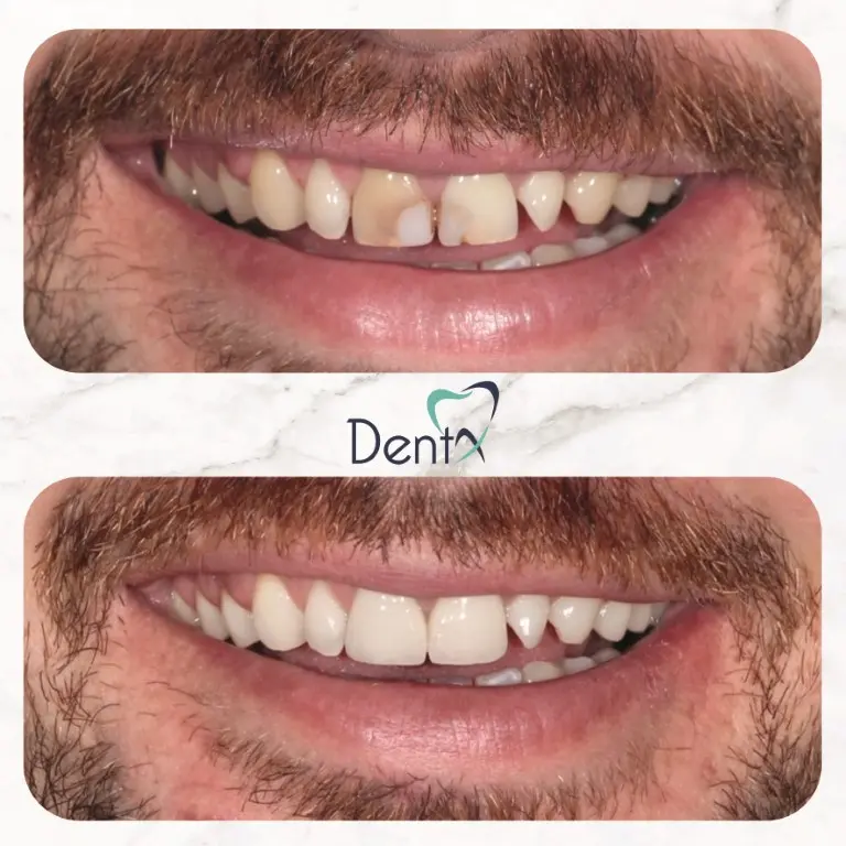 Dentx-Digital-Smile-Design-Hollywood-Smile-Before-Afters-33