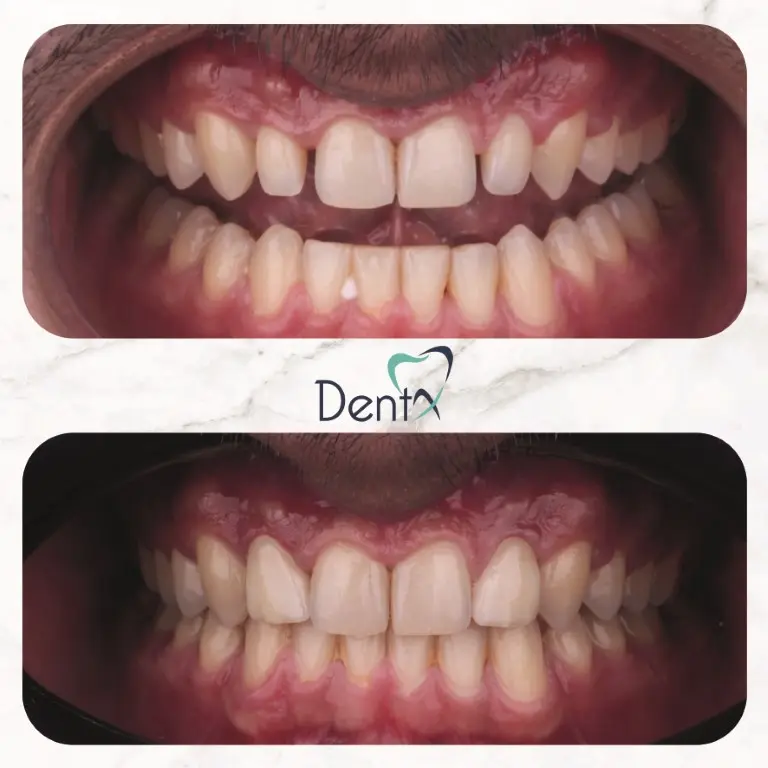 Dentx-Digital-Smile-Design-Hollywood-Smile-Before-Afters-34