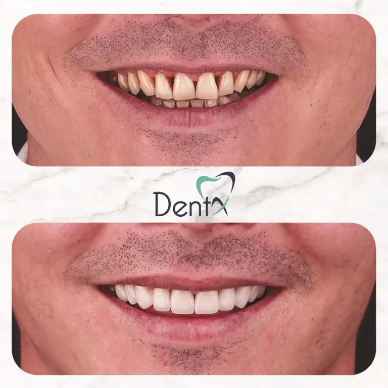 Dentx-Digital-Smile-Design-Hollywood-Smile-Before-Afters-35