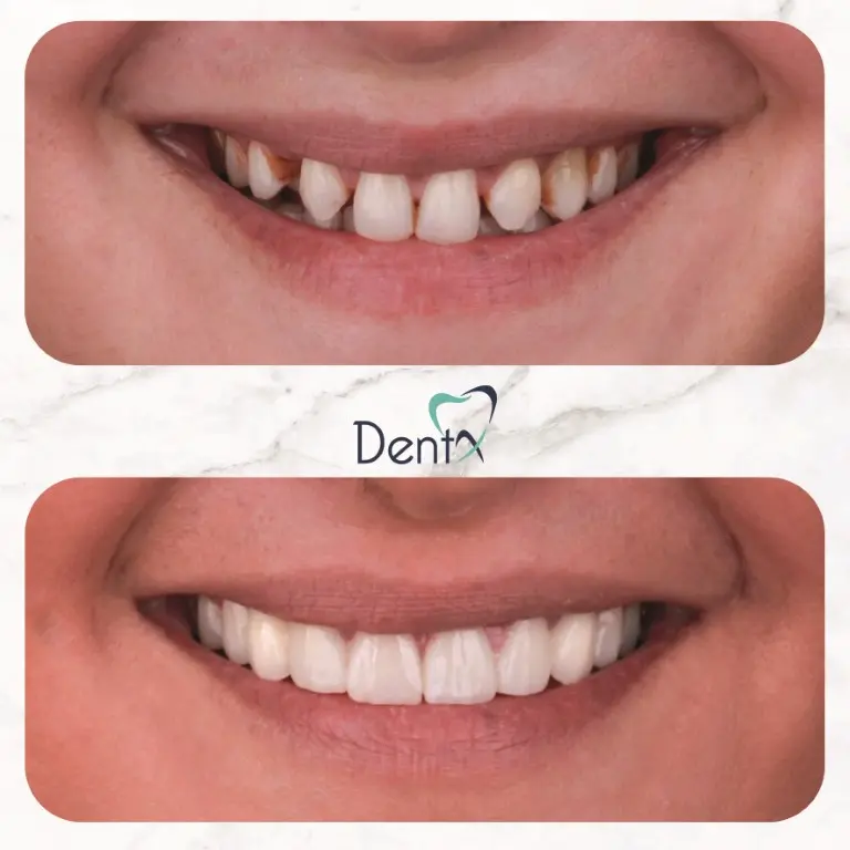 Dentx-Digital-Smile-Design-Hollywood-Smile-Before-Afters-36