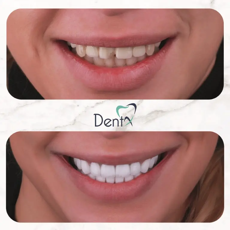 Dentx-Digital-Smile-Design-Hollywood-Smile-Before-Afters-37