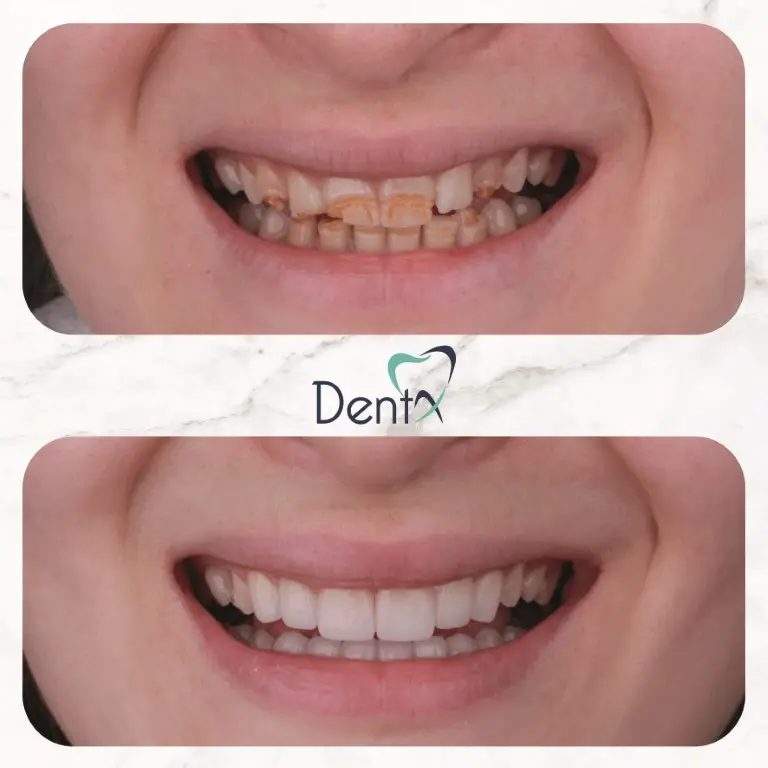 Dentx-Digital-Smile-Design-Hollywood-Smile-Before-Afters-38