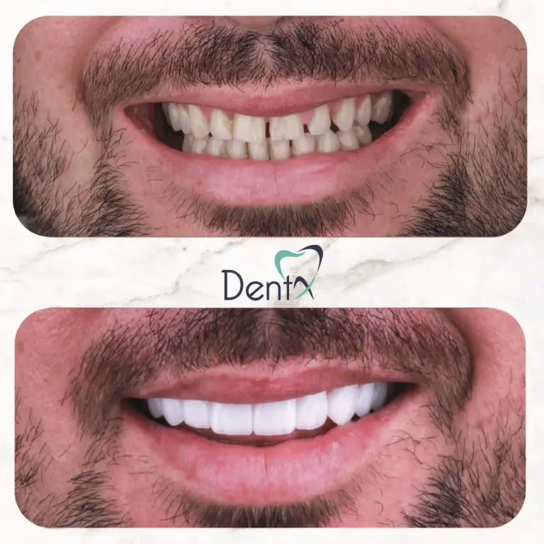 Dentx-Digital-Smile-Design-Hollywood-Smile-Before-Afters-39