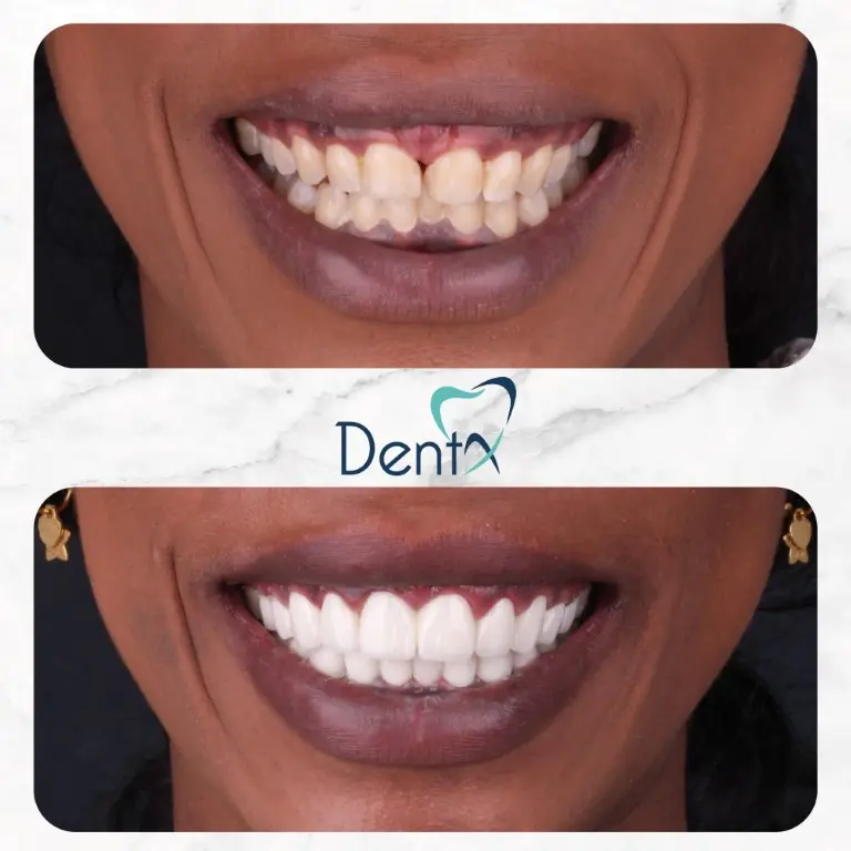 Dentx-Digital-Smile-Design-Hollywood-Smile-Before-Afters-4