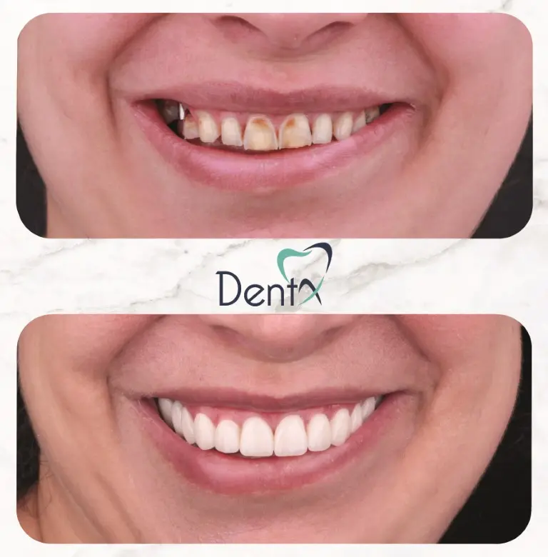 Dentx-Digital-Smile-Design-Hollywood-Smile-Before-Afters-40