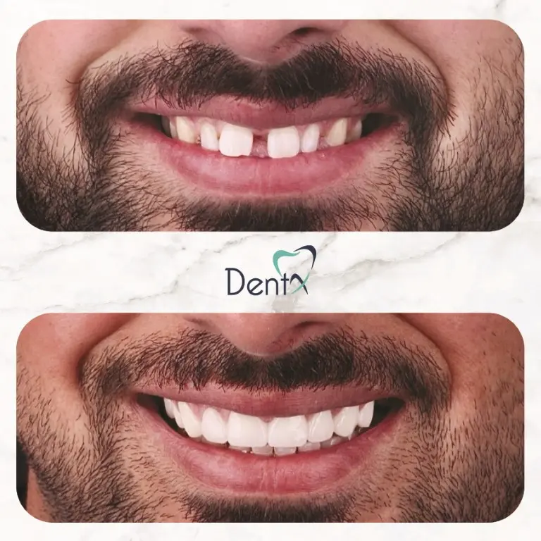 Dentx-Digital-Smile-Design-Hollywood-Smile-Before-Afters-41