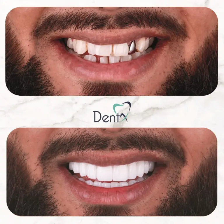 Dentx-Digital-Smile-Design-Hollywood-Smile-Before-Afters-42