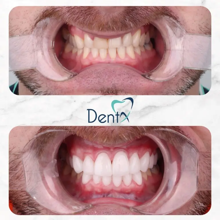 Dentx-Digital-Smile-Design-Hollywood-Smile-Before-Afters-5