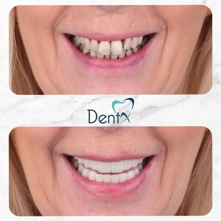 Dentx-Digital-Smile-Design-Hollywood-Smile-Before-Afters-6