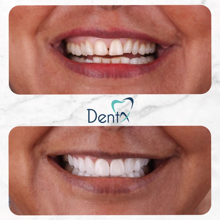 Dentx-Digital-Smile-Design-Hollywood-Smile-Before-Afters-7