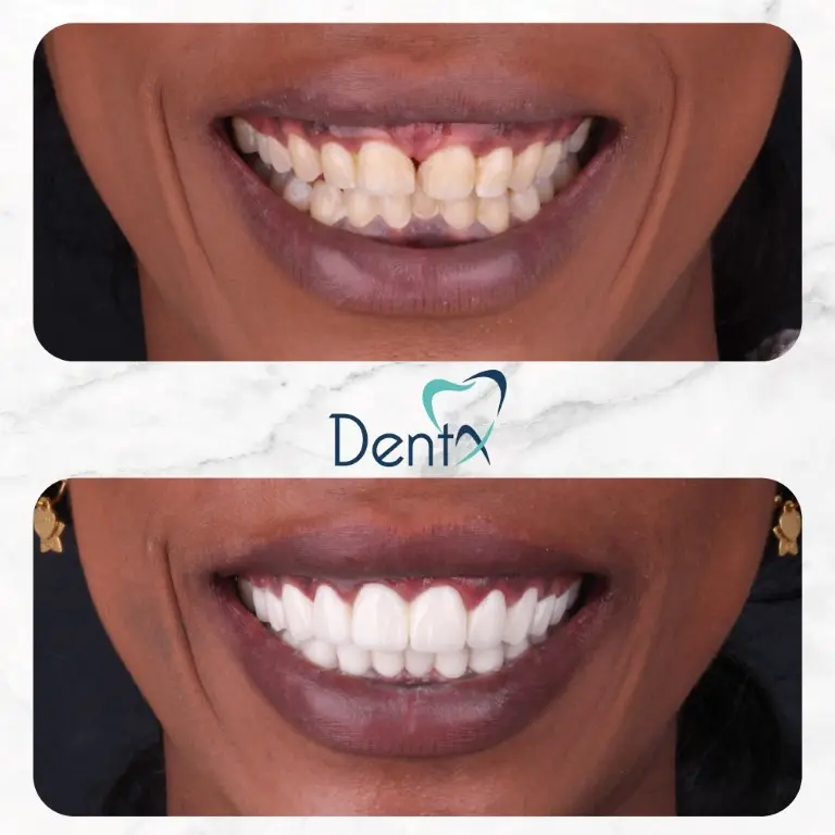 Dentx-Digital-Smile-Design-Hollywood-Smile-Before-Afters-8
