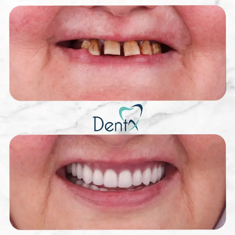 Dentx-Digital-Smile-Design-Hollywood-Smile-Before-Afters-9