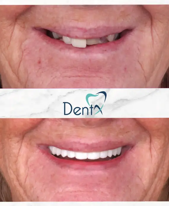 dentx-dental-implant