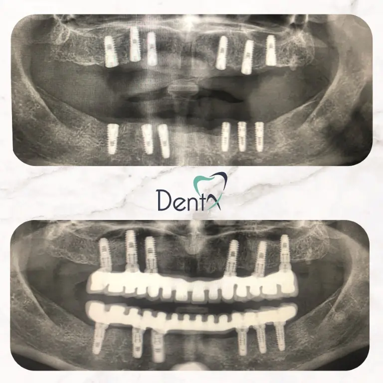 Dentx-Dental-Implant-Before-Afters-4