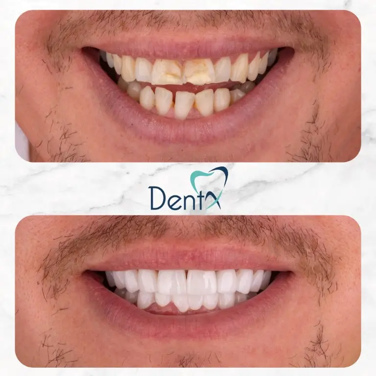 Dentx-Digital-Smile-Design-Hollywood-Smile-Before-Afters-14