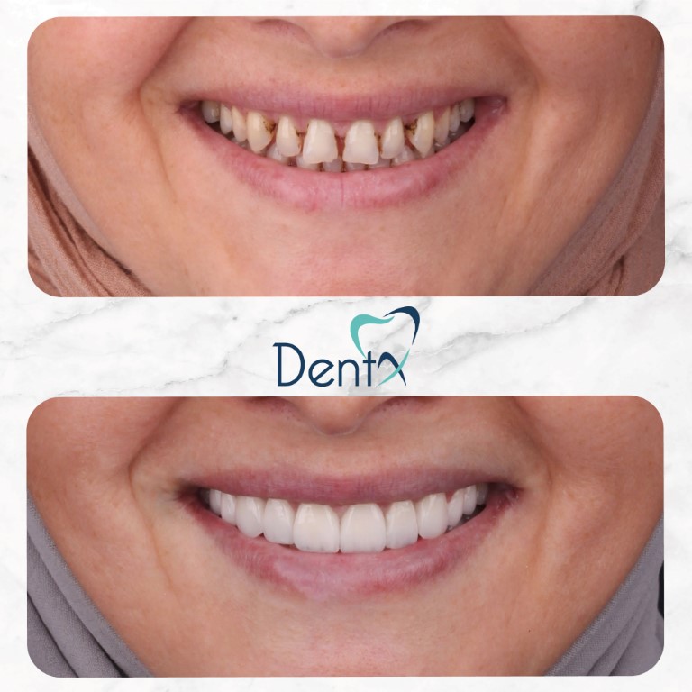 Dentx-Digital-Smile-Design-Hollywood-Smile-Before-Afters-16