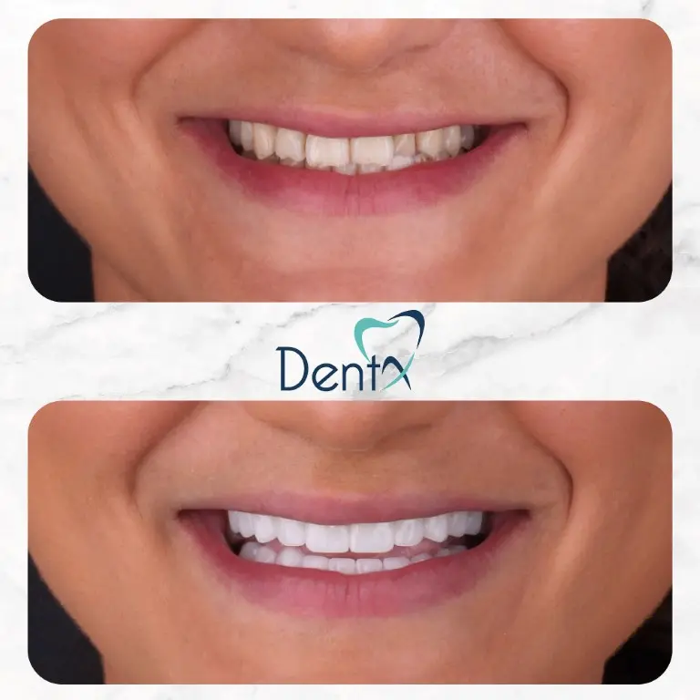 Dentx-Digital-Smile-Design-Hollywood-Smile-Before-Afters-17