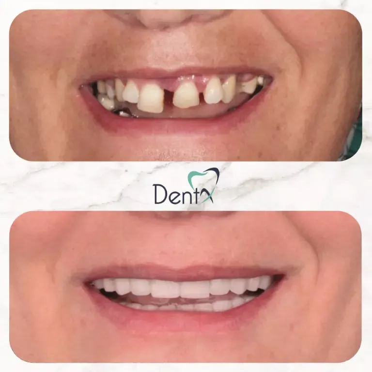 Dentx-Digital-Smile-Design-Hollywood-Smile-Before-Afters-25