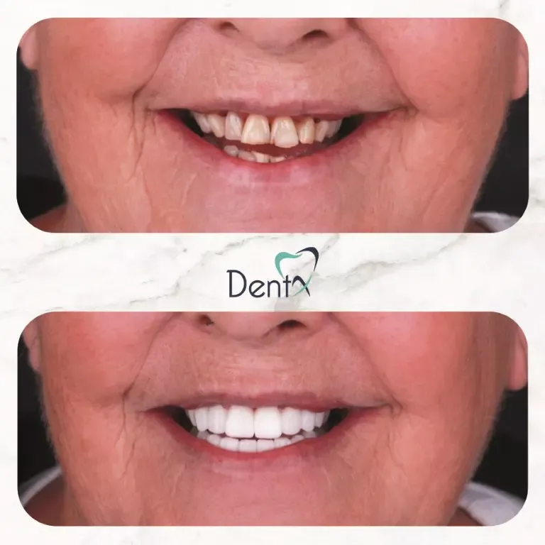 Dentx-Digital-Smile-Design-Hollywood-Smile-Before-Afters-26