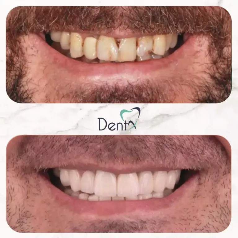 Dentx-Digital-Smile-Design-Hollywood-Smile-Before-Afters-27